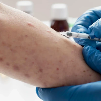 Kemenkes Ingatkan Waspada Campak Jelang Mudik Lebaran, Imunisasi Anak Jadi Kunci