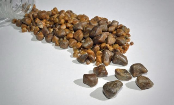 Dr. Irsan Hasan Ungkap Fakta tentang Batu Empedu: Penyebab, Jenis, dan Pentingnya Identifikasi yang Tepat